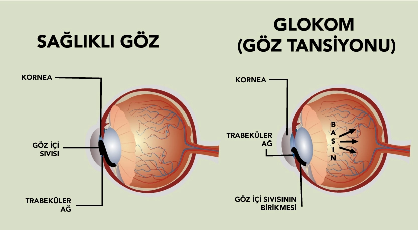 Göz Tansiyonu