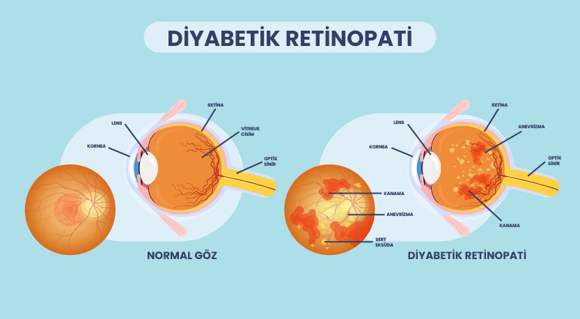 Diyabete Bağlı Göz Hastalıklarında Hangi Tedaviler Yapılır?