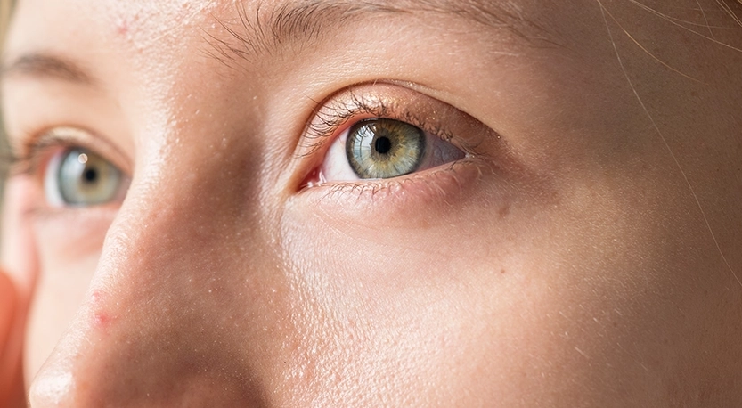 Göz Kuruluğu Olanlar İçin Lens Kullanımında Dikkat Edilmesi Gereken Noktalar