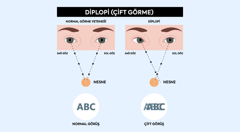 Diplopi