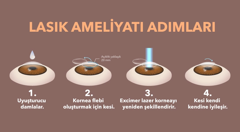 Lazer Göz Ameliyatları